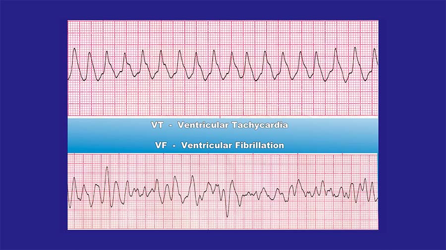 basic life support CPR AED rythms